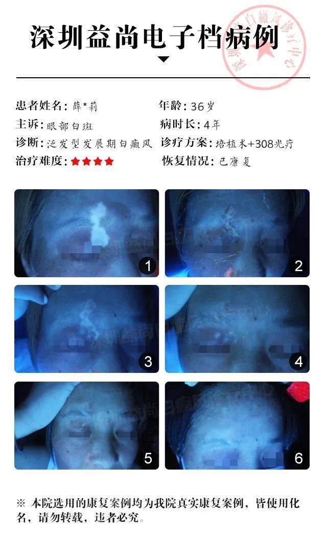 温州白癜风治疗新技术探索与突破